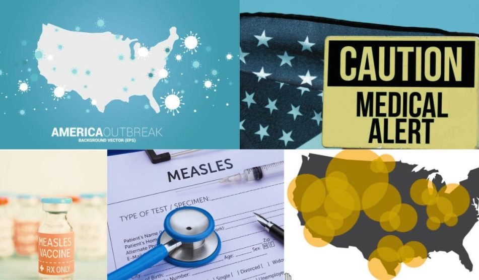 measles